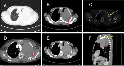 Case report: Primary pleural giant extraskeletal Ewing sarcoma in a child
